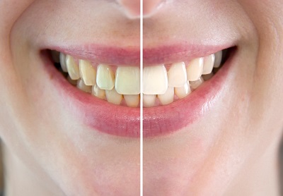 Tooth Whitening Before After